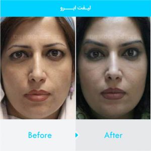 brow-lift-101
