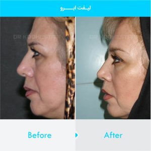 brow-lift-109