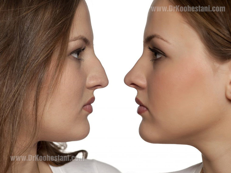 Secondary and Reconstructive Rhinoplasty 