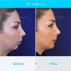 chin-implant-102