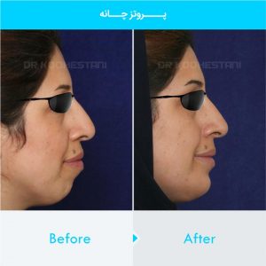 chin-implant-104