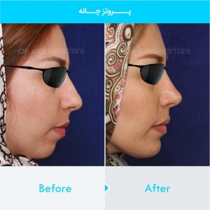 chin-implant-108