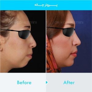 chin-implant-110