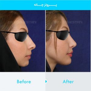 chin-implant-115