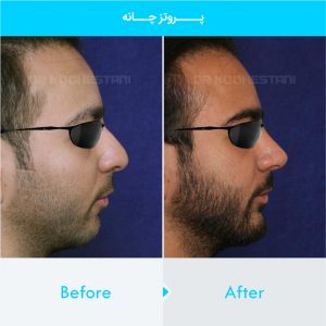 chin-implant-123