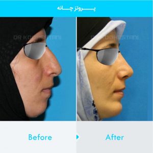 chin-implant-124