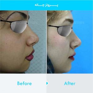 chin-implant-125