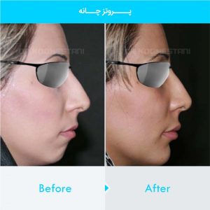 chin-implant-126