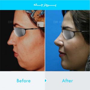 chin-implant-130