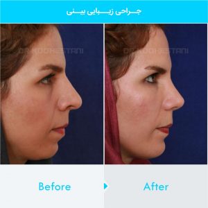 chin-implant-133