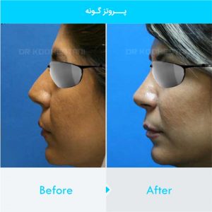 cheek-augmentation-102