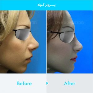 cheek-augmentation-105