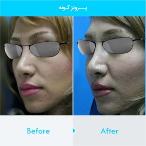 cheek-augmentation-109