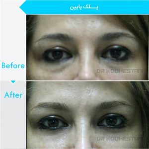 eyelid-surgery-1001