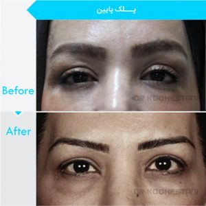 eyelid-surgery-1005