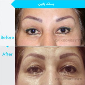 eyelid-surgery-1007