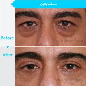 eyelid-surgery-1008