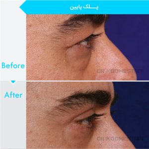 eyelid-surgery-1009