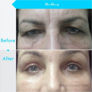 eyelid-surgery-103