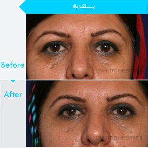 eyelid-surgery-104