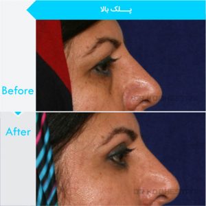 eyelid-surgery-105
