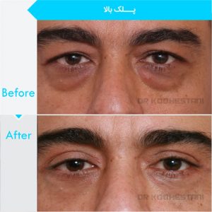 eyelid-surgery-106