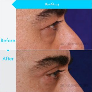 eyelid-surgery-107