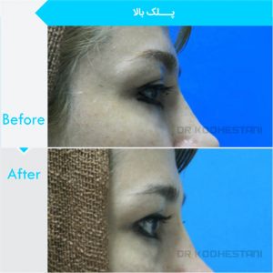 eyelid-surgery-109