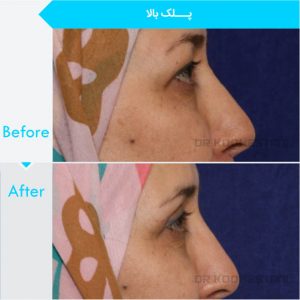 eyelid-surgery-115
