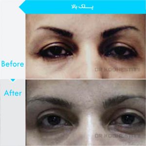 eyelid-surgery-122