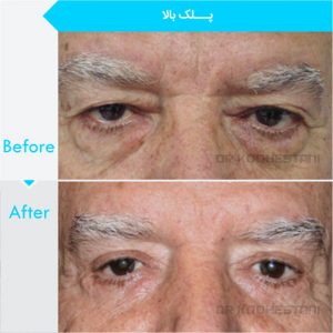eyelid-surgery-124