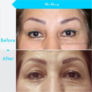 eyelid-surgery-125