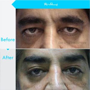 eyelid-surgery-128