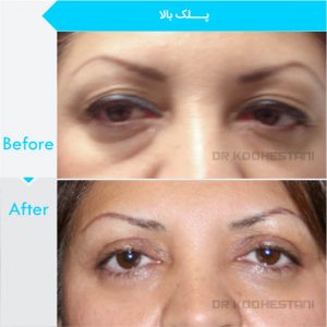 eyelid-surgery-132