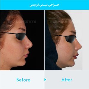 revision-rhinoplasty-102