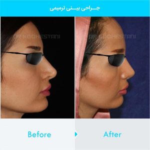 revision-rhinoplasty-107