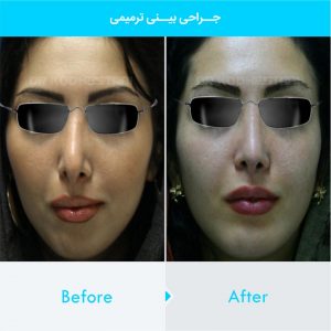 revision-rhinoplasty-109