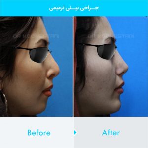 revision-rhinoplasty-110