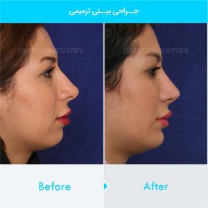 revision-rhinoplasty-117