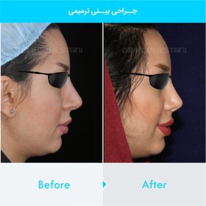 revision-rhinoplasty-120