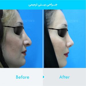 revision-rhinoplasty-123