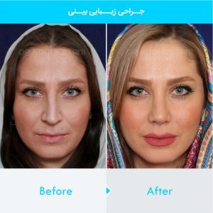 rhinoplasty-101