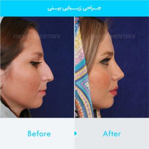 rhinoplasty-102