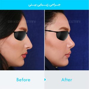 rhinoplasty-105