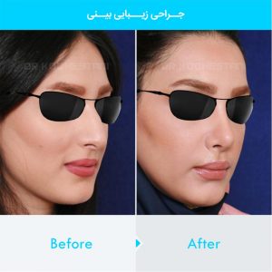 rhinoplasty-106