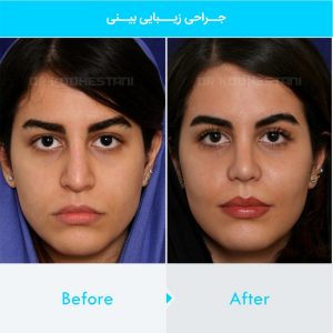 rhinoplasty-107