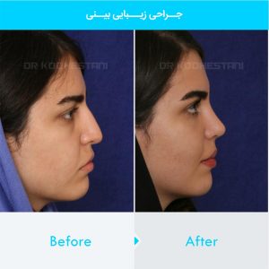 rhinoplasty-108