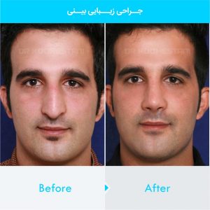 rhinoplasty-110