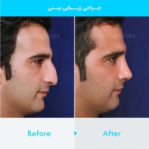 rhinoplasty-111