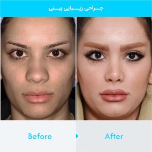 rhinoplasty-113